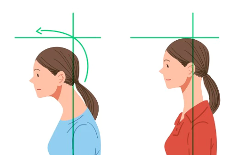 거북목증후군-증상-이미지
