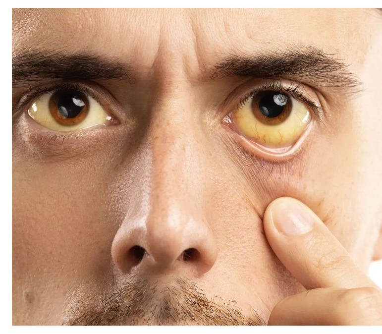 황달 증상 이미지