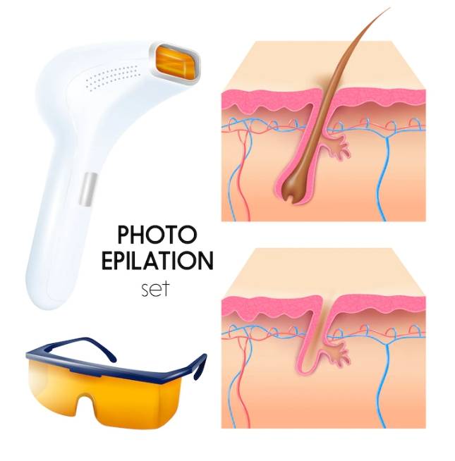 레이저를 이용한 제모방법 소개