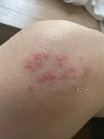 경기도 대상포진 무료접종 연령 기준 정리로 안내_7