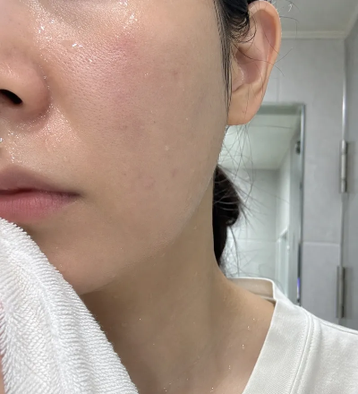 리쥬란 시술 후 속건조가 개선되어 욕실에서 세안을 마친 직후 물기가 남아 있는 상태의 촉촉한 볼 피부 민낯 후기 사진