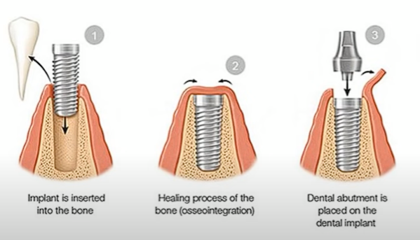 임플란트 시술 과정
