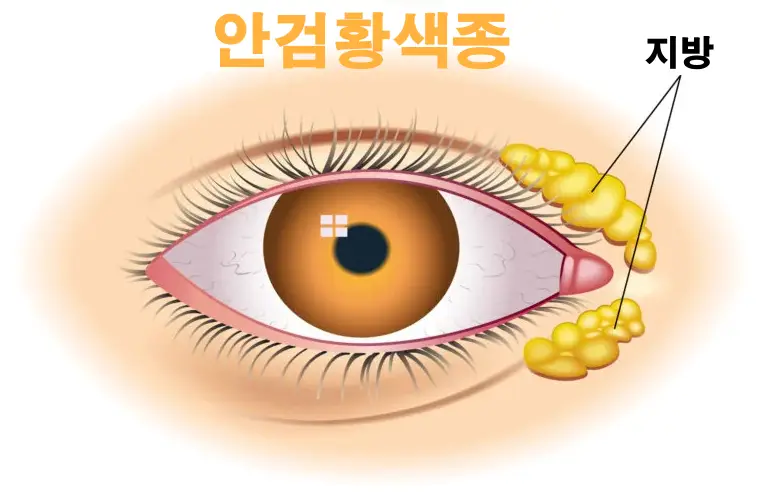 안검-황색종