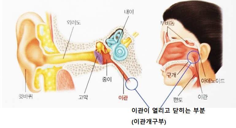 이관개방증 설명