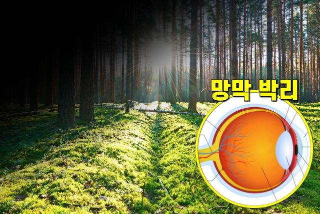 실명 전조증상 5,눈이 커튼처럼 가려보이는 증상,팁줌