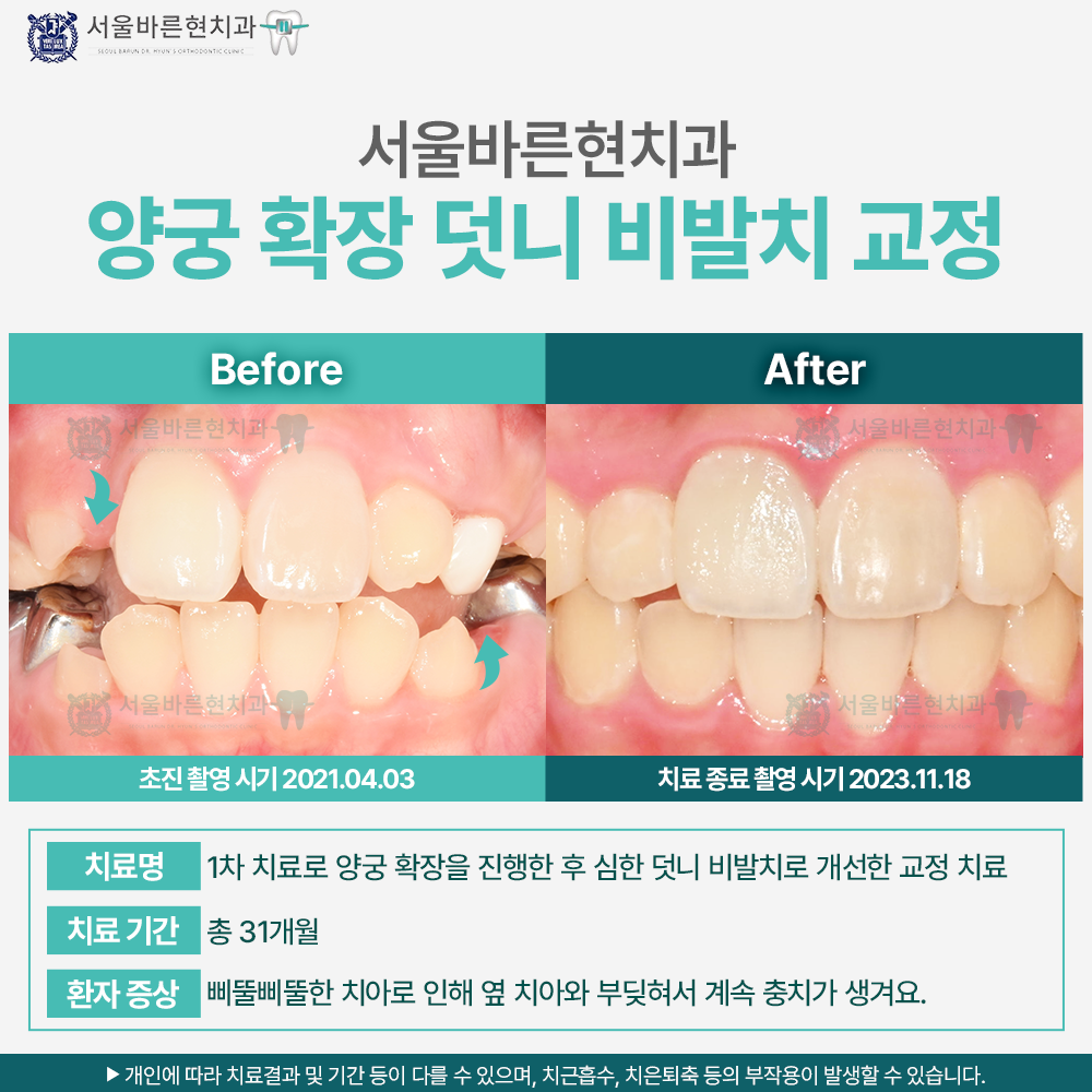 마린시티치아교정