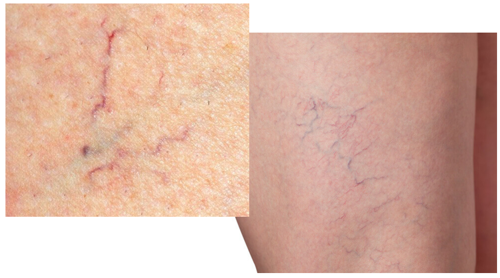 하지정맥류 증상