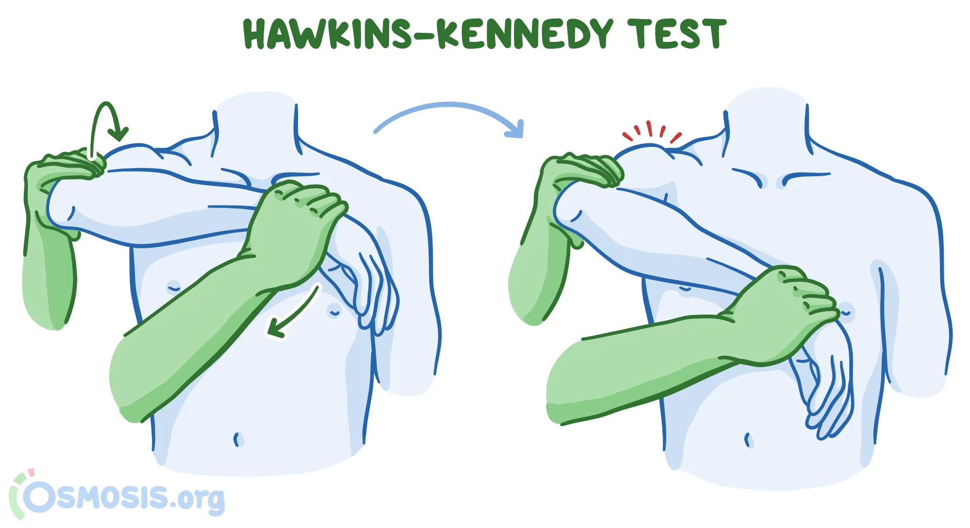 어깨충돌증후군4