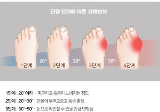 무지외반증, 여름철 신발이 발 건강에 미치는 영향 관련 이미지