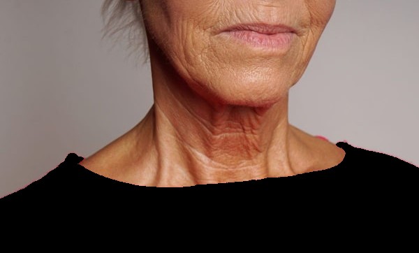 가로 목 주름 원인