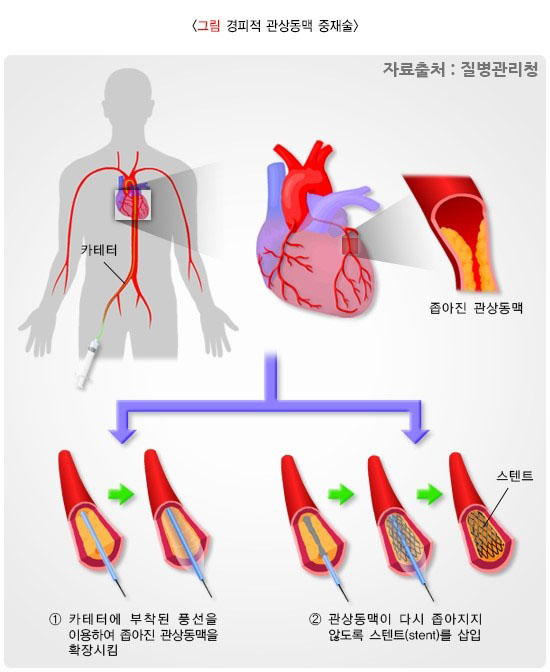 경피적 관상동맥 중재술(PCI)