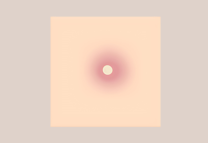 농이-가득찬-비립종