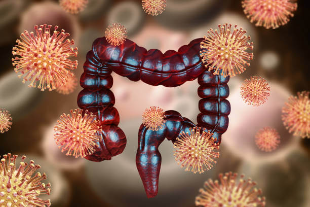 허혈성 대장염 증상과 원인, 치료방법, 예방법