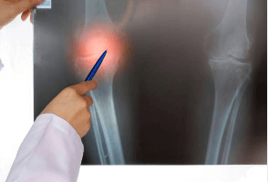 골다공증 뼈 건강