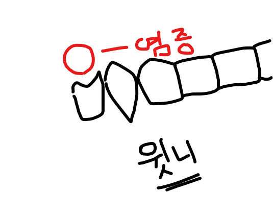 임플란트 하게 된 윗니