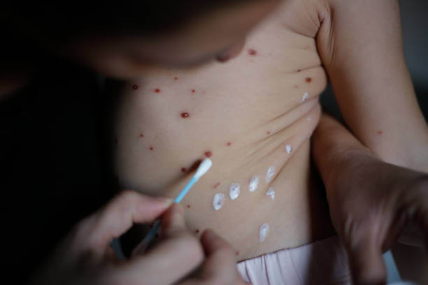 패인 수두 자국, 어떻게 없앨까? 효과적인 방법과 병원 선택 꿀팁