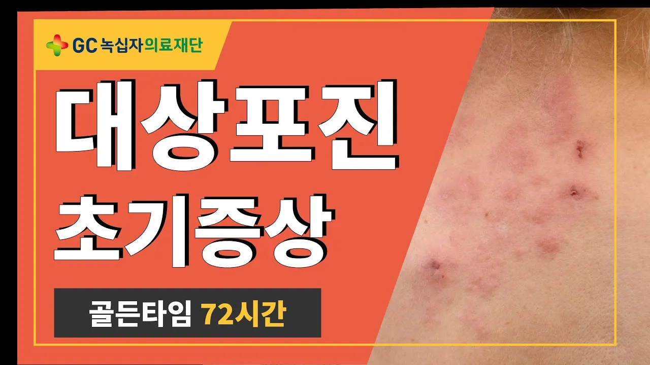 대상포진 감염 증상 부위 손 허리 허벅지_5