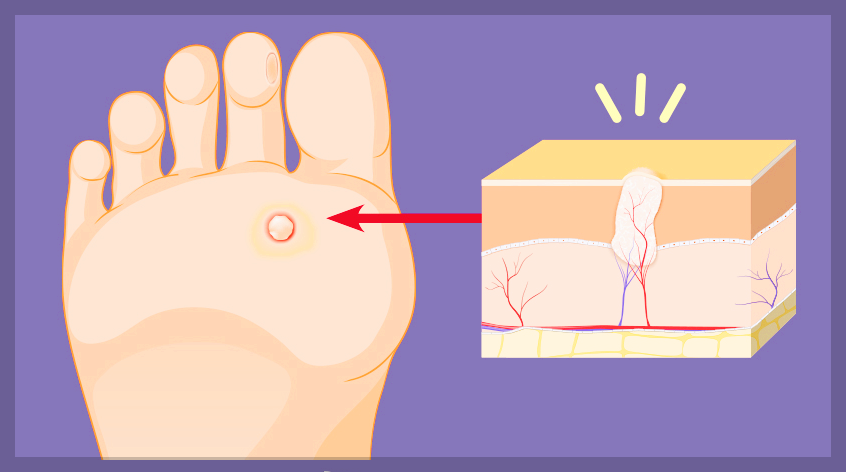 사마귀 증상, 생기는 원인, 제거 하는 방법