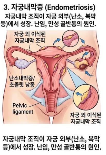 자궁선근증