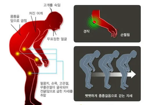 파킨슨병 증상 및 예방방법
