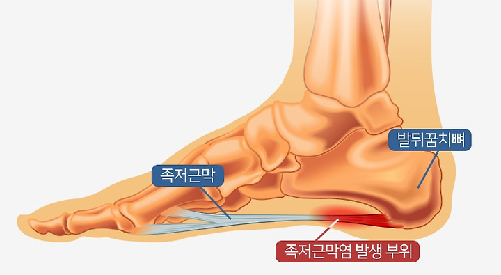 족저근막염 증상