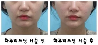 덴서티 리프팅 댄서티 가격 효과 유지기간에 관한 정보_3