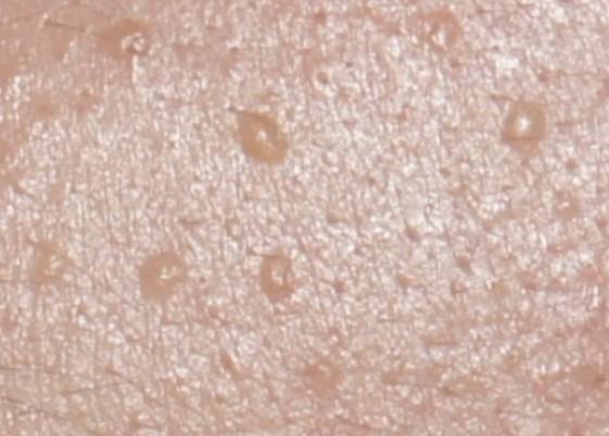 편평사마귀 없애는 방법