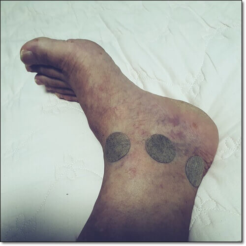 발목 불안정증 증상