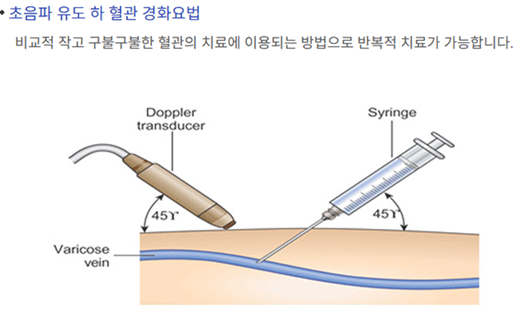 다리가-붓는-이유-하지정맥류-수술비용