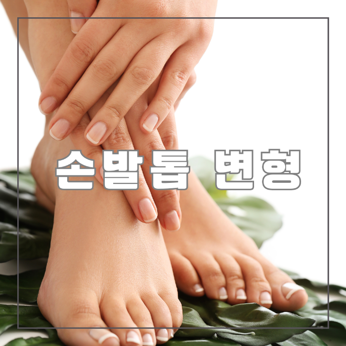 손톱 발톱 변형