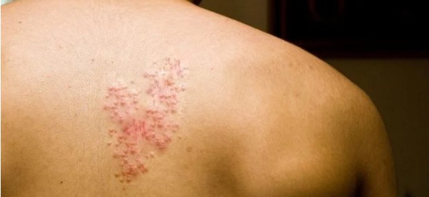 대상포진 초기증상, 대상포진 치료방법, 대상포진 예방접종 가격