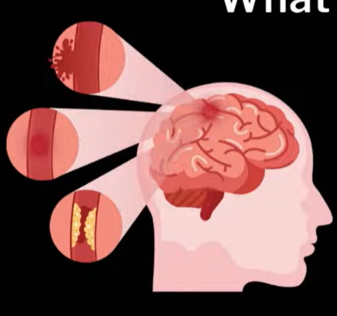 뇌경색 전조증상
