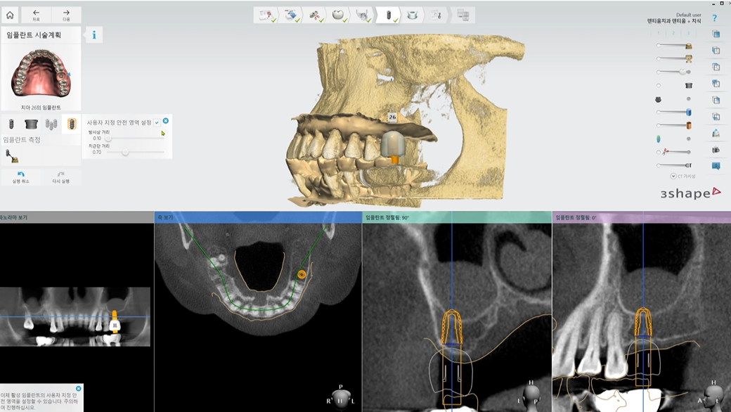 네비게이션 임플란트란?