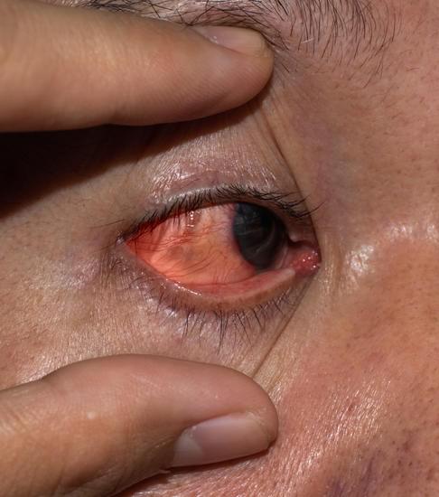 각막염 (Keratitis): 원인, 증상, 진단 및 치료 방법