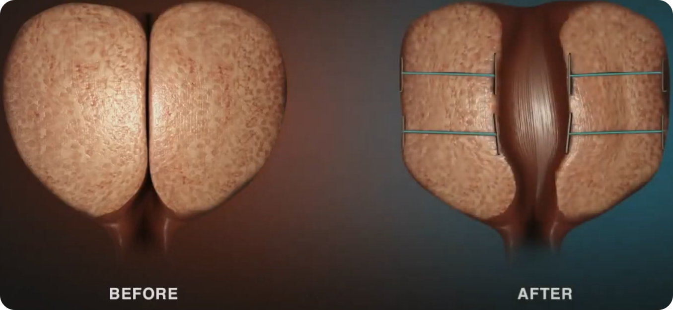 전립선 비대증 수술 비용