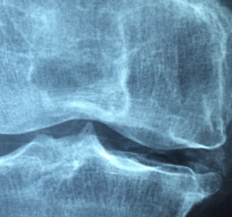 관절 파열 정형외과