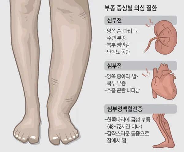 부종의 원인과 증상 5가지 개선방법 치료법_5