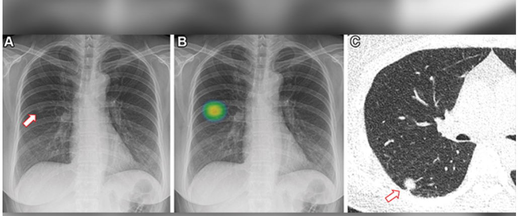서울대-흉부X선-검사