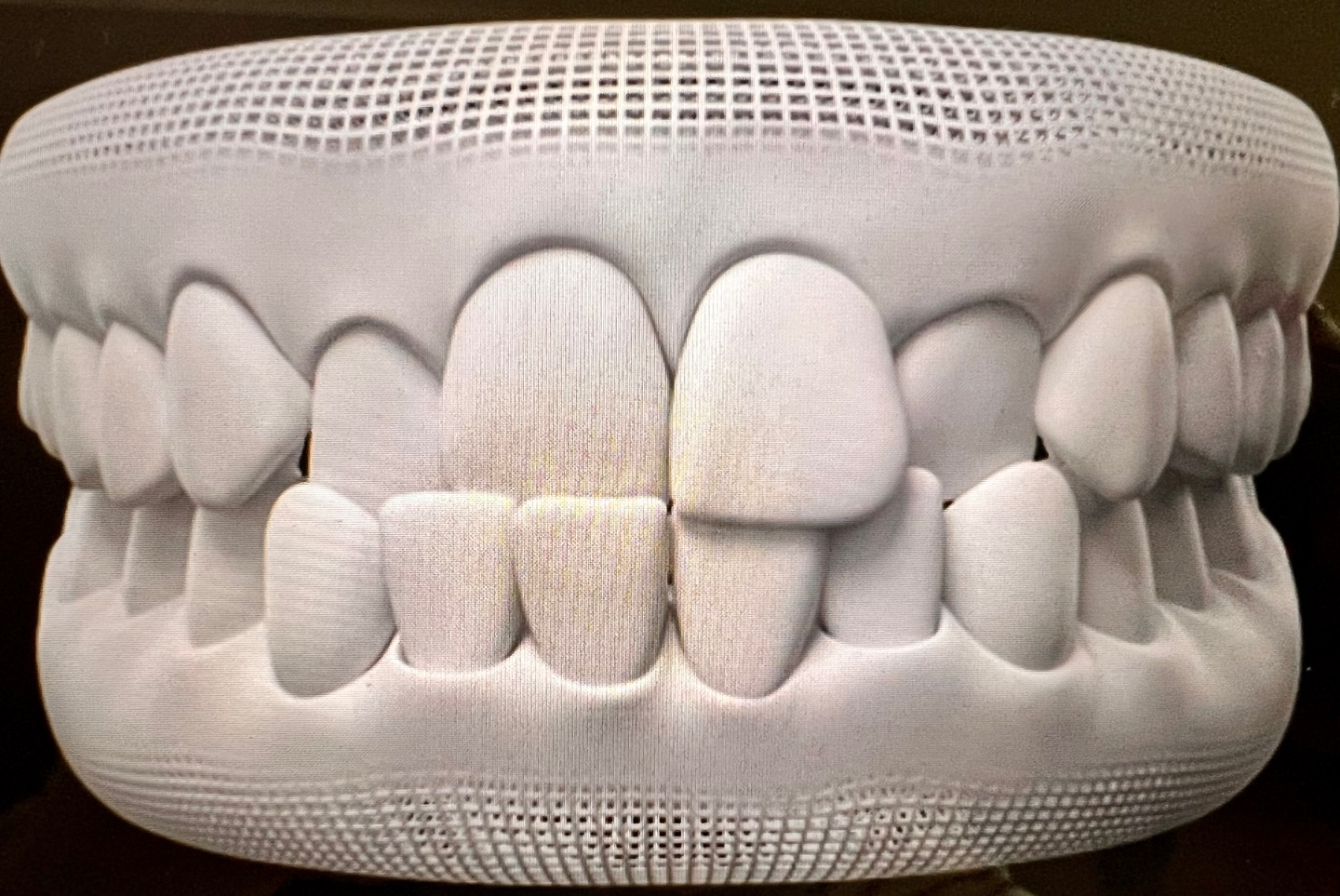 인비절라인 케이스, 교차교합으로 앞니의 교합이 엉망이다