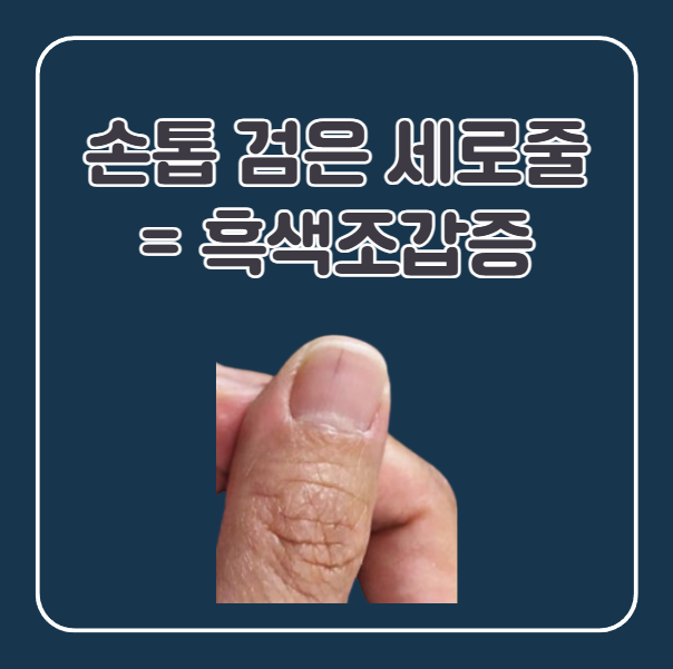 손톱 및 검은 세로줄은 흑색조갑증이라 부른다