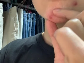 생리 전 뾰루지 폭발 원인과 해결법 7가지 생리 전후 뾰루지 발생 이유 완벽 분석_5