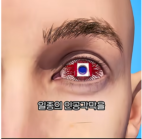 치아로 만든 렌즈르 고정해 시력을 회복한다.