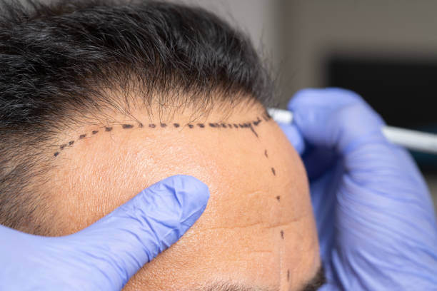 헤어라인 교정부터 정수리 탈모까지? 머리심는 비용 최신 정보!