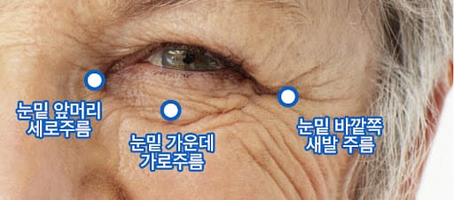 눈밑꺼짐, 눈밑주름 없애는 방법! 눈밑지방 없애는 마사지 TIP