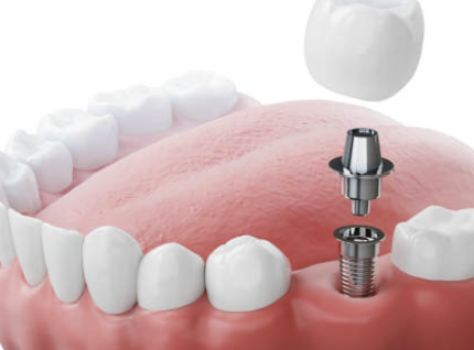 임플란트 시술과정