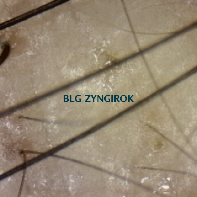 탈모 극복프로젝트 - 피나모아 복용 - 오른쪽 M자 부위 두피사진 모습이다.