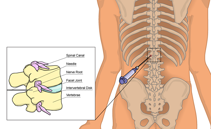척추 통증 관리의 최전선 - 허리 신경차단술의 비용과 효과