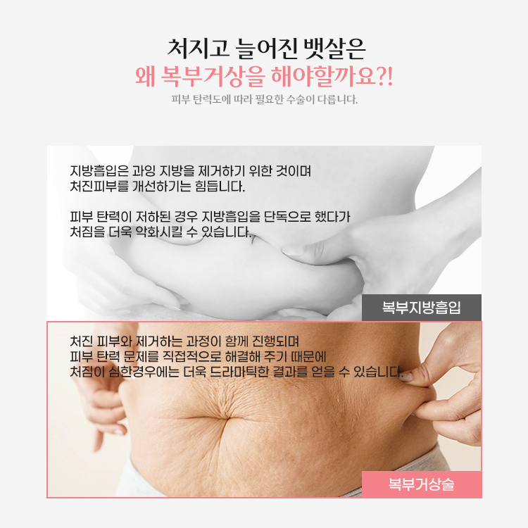 처진피부와 제거하는 과정이 함께 진행되며 피부 탄력 문제를 직접적으로 해결해주기 때문에 처짐이 심한 경우에는 복부거상수술이 더욱 드라마틱한 결과를 얻을 수 있습니다.