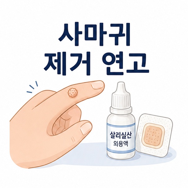 손가락의 작은 사마귀와 바르는 외용제, 패치를 함께 배치해 사마귀 제거 연고를 설명하는 대표 이미지