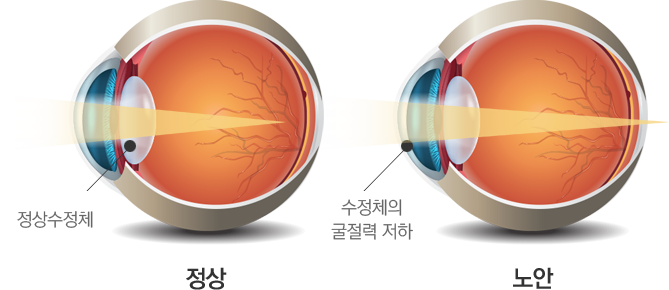 노안 이미지